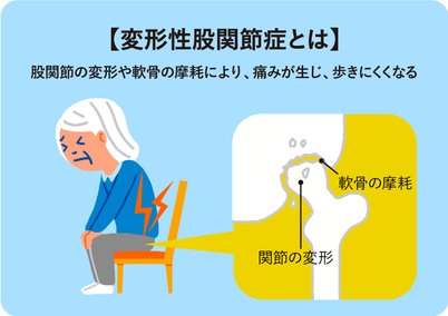 介護保険の特定疾病 変形性股関節症とは Lifull介護 旧home S介護