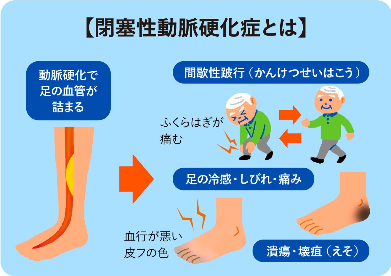 介護保険の特定疾病、閉塞性動脈硬化症(ASO)とは? - LIFULL 介護(ライフル介護)