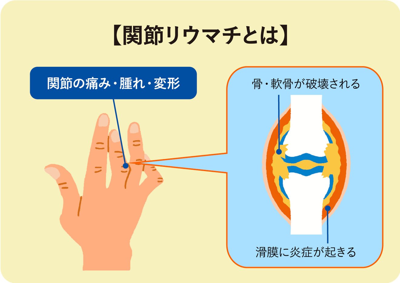 進行性関節リウマチについて知っておくべきこと