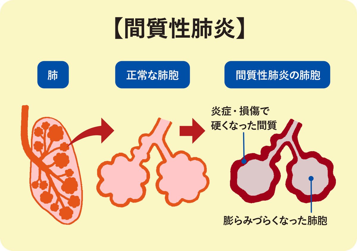 肺炎は伝染性ですか?