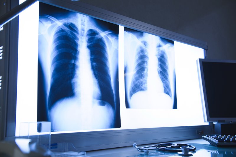 親が肺がんになったらーー知っておきたい治療の選択肢 Tayorini By Lifull介護