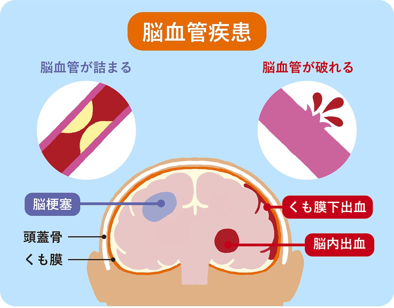 脳卒中の疑いがある場合はどうすればよいですか?