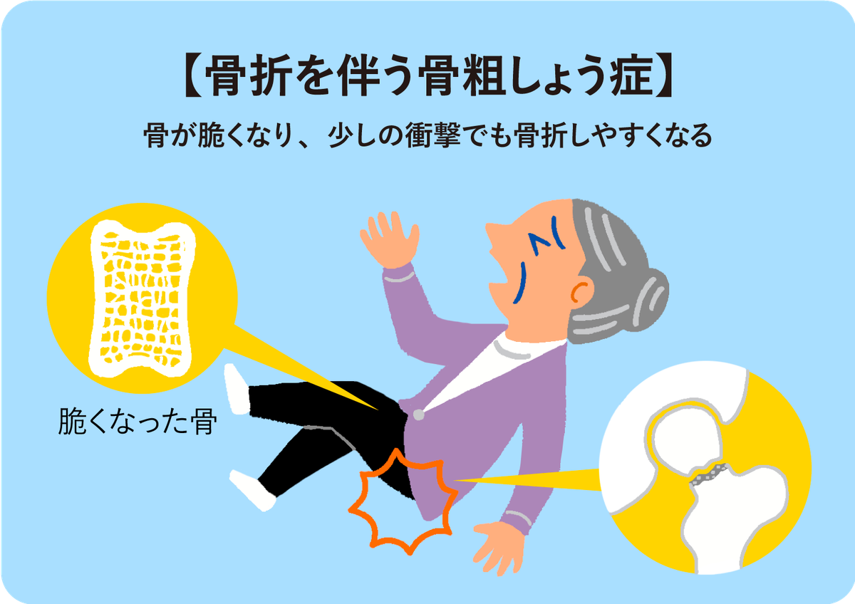 特定疾病の 骨折を伴う骨粗しょう症 とは Lifull介護 旧home S介護
