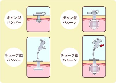 胃ろうカバー注文ページ （在宅での胃瘻栄養管理と胃瘻カテーテルの 